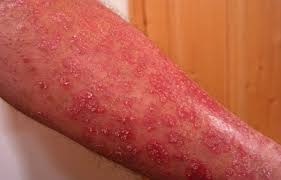 Pellagra