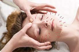 Acupuncture session supporting natural energy flow and wellness for ear ringing relief